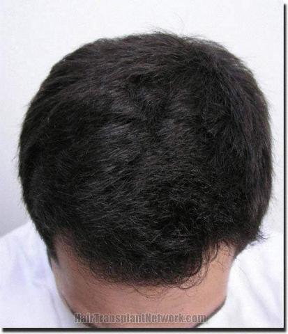 Hair restoration procedure results