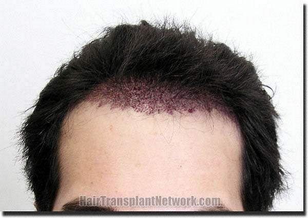 Hair restoration procedure results