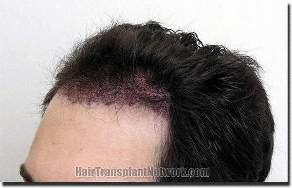 Hair restoration procedure results