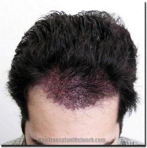 Hair restoration procedure results