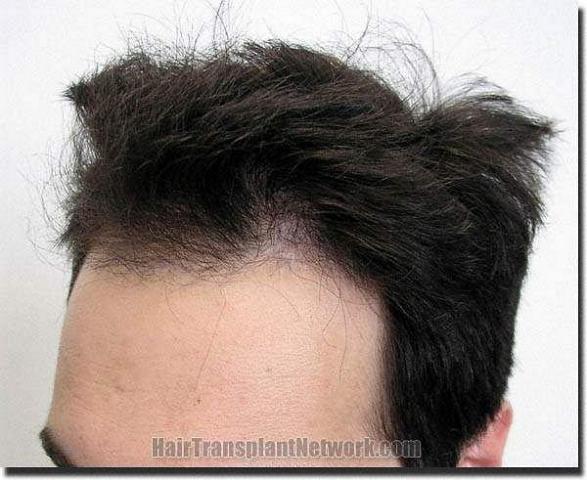 Hair restoration procedure results