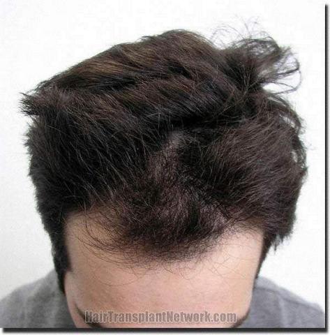 Hair restoration procedure results