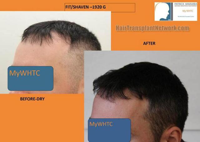 Hair transplantation surgery before and after images