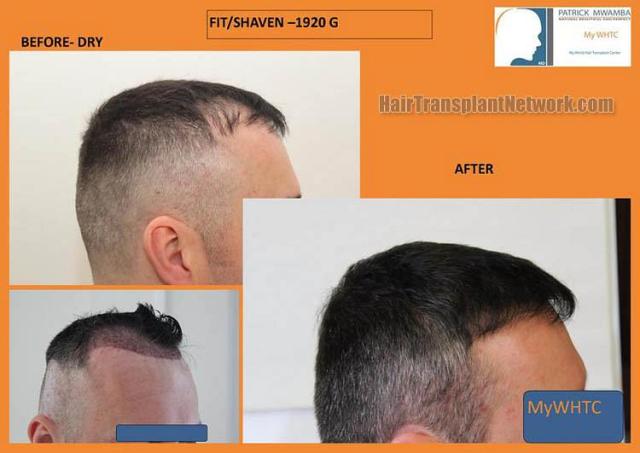 Hair transplantation surgery before and after photos