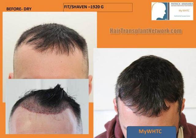 Hair restoration procedure before and after results