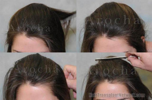 Female hair restoration patient