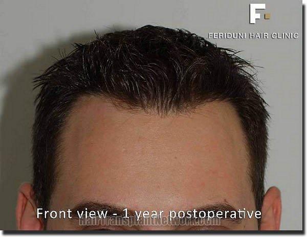 Hair restoration procedure results