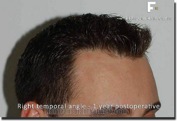 Hair restoration procedure results