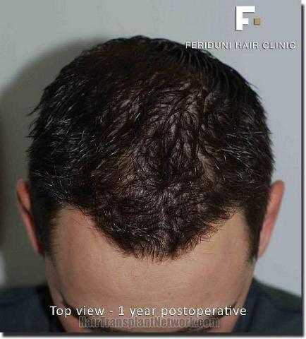 Hair restoration procedure results