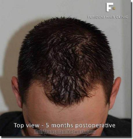 Hair restoration procedure results