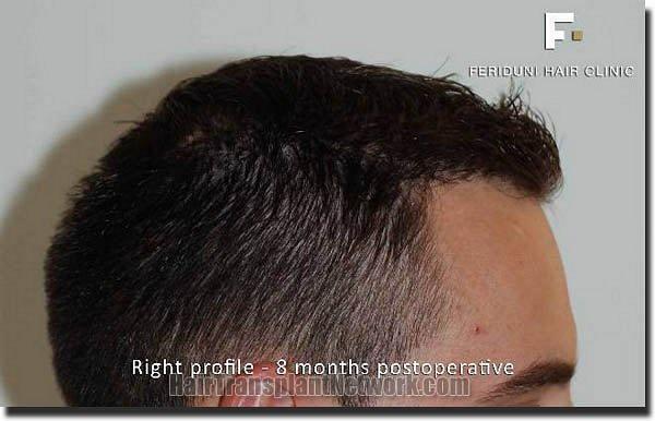 Hair restoration procedure results