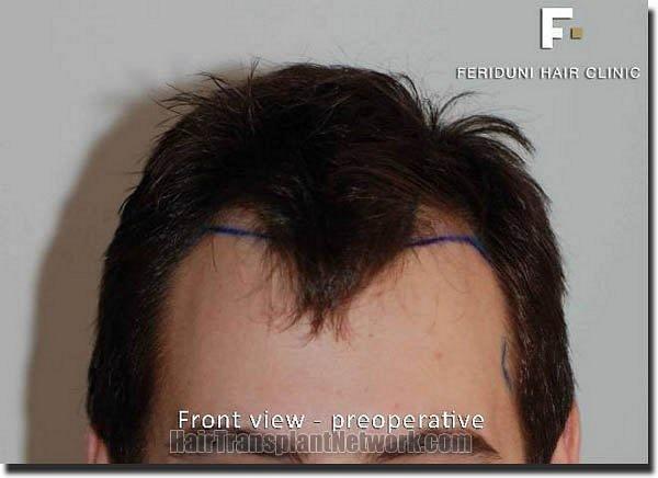 Hair restoration procedure results