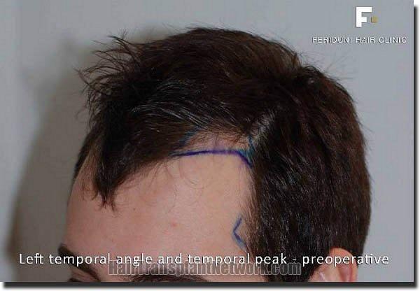 Hair restoration procedure results