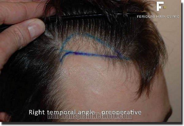 Hair restoration procedure results