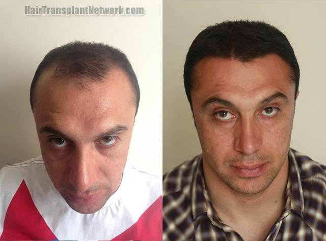 Before and after hair transplantation result photographs