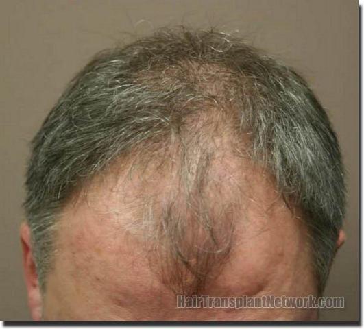 Hair restoration procedure results