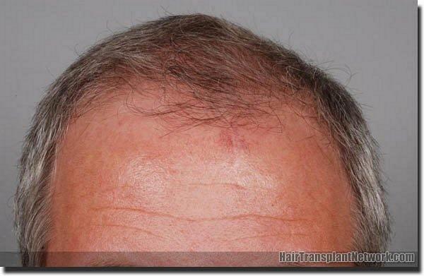 Hair restoration procedure results