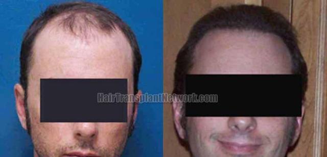 Hair transplantation surgery before and after photos