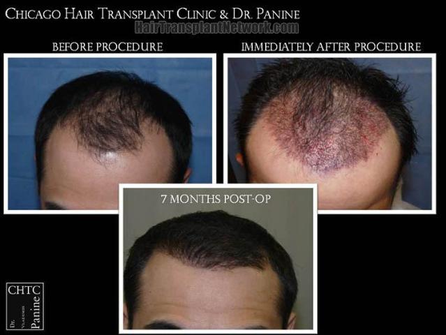 Hair restoration procedure before and after results