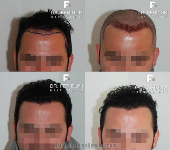 Before and after hair transplant procedure images