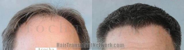 Hair restoration procedure before and after results