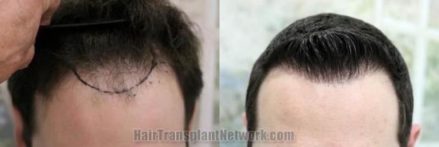 Hair restoration procedure before and after pictures