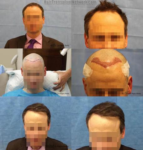 Hair transplantation surgery before and after images