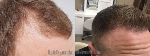 Hair restoration procedure before and after pictures