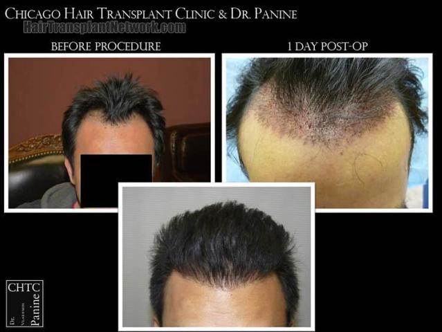 Hair restoration procedure before and after results