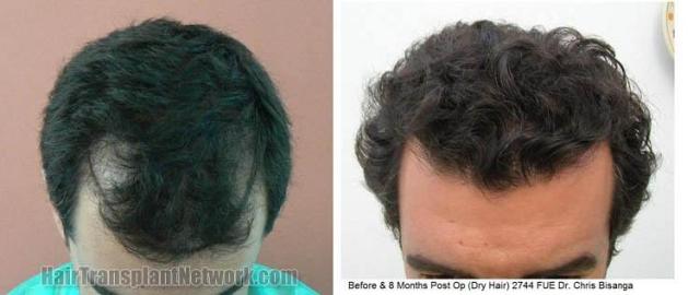 Hair restoration procedure before and after results