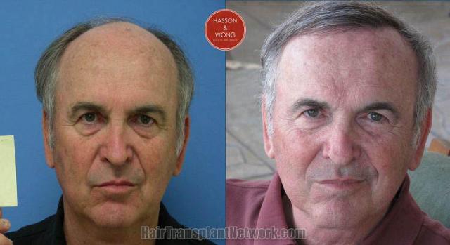 Hair restoration procedure before and after results