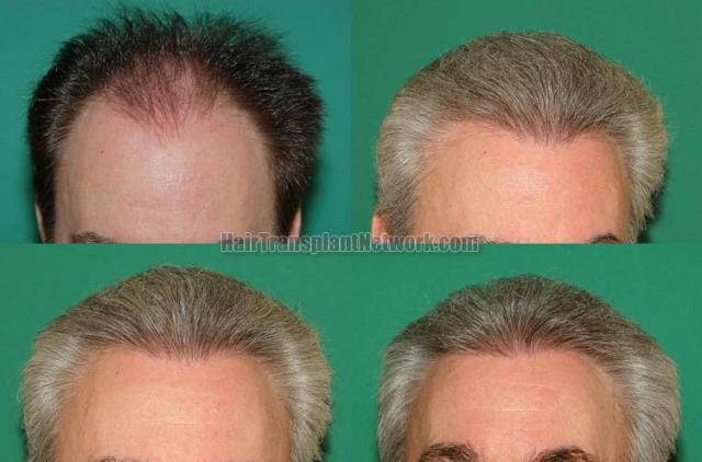 Hair restoration procedure before and after results