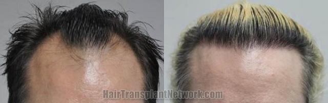 Hair transplantation surgery before and after pictures