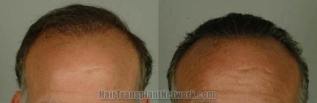 Before and after hair transplant procedure images