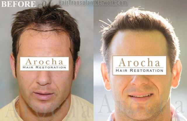 Hair restoration procedure before and after results