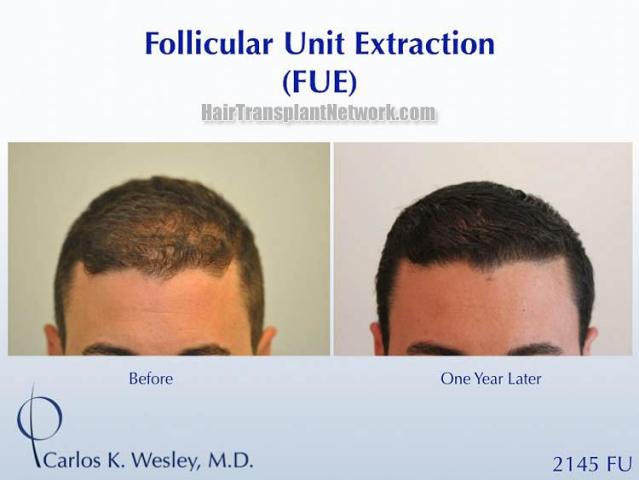 Hair restoration procedure before and after results