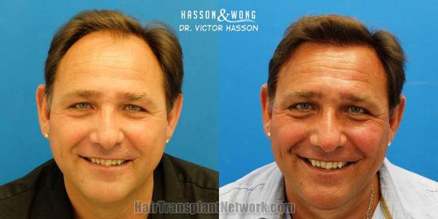 Hair restoration procedure before and after results