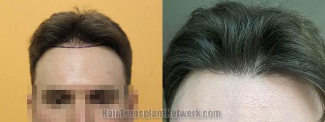 Before and after hair transplant procedure images