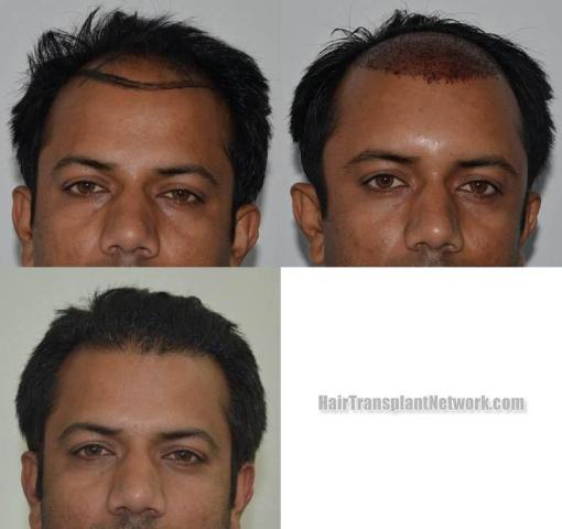 Before and after hair transplant procedure images