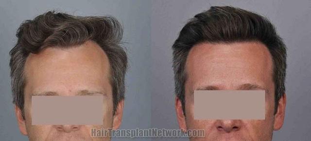 Hair transplantation surgery before and after images