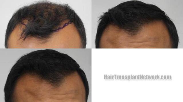 Hair restoration procedure before and after results