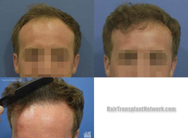 Hair restoration procedure before and after results