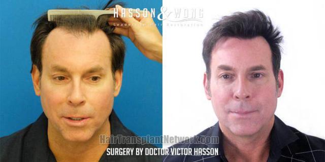 Front view - Before and after hair restoration procedure