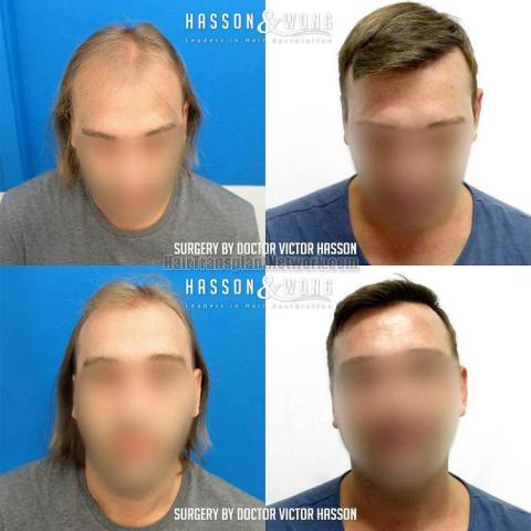 Front view - Before and after hair restoration procedure