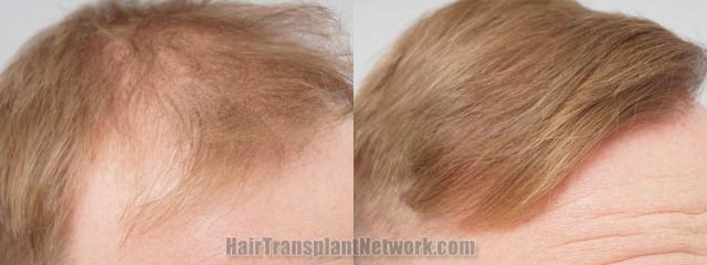 Hair restoration procedure before and after pictures