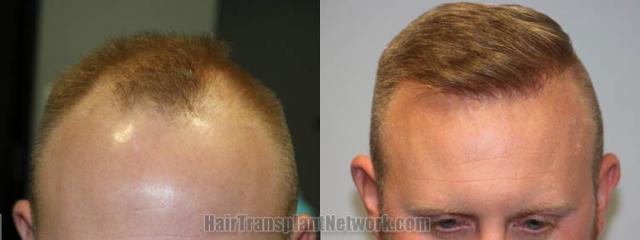   before and after result photographs