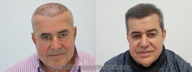   before and after result photographs