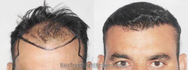   before and after result photographs