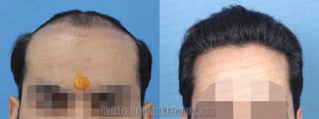   before and after result photographs