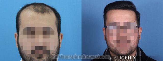   before and after result photographs